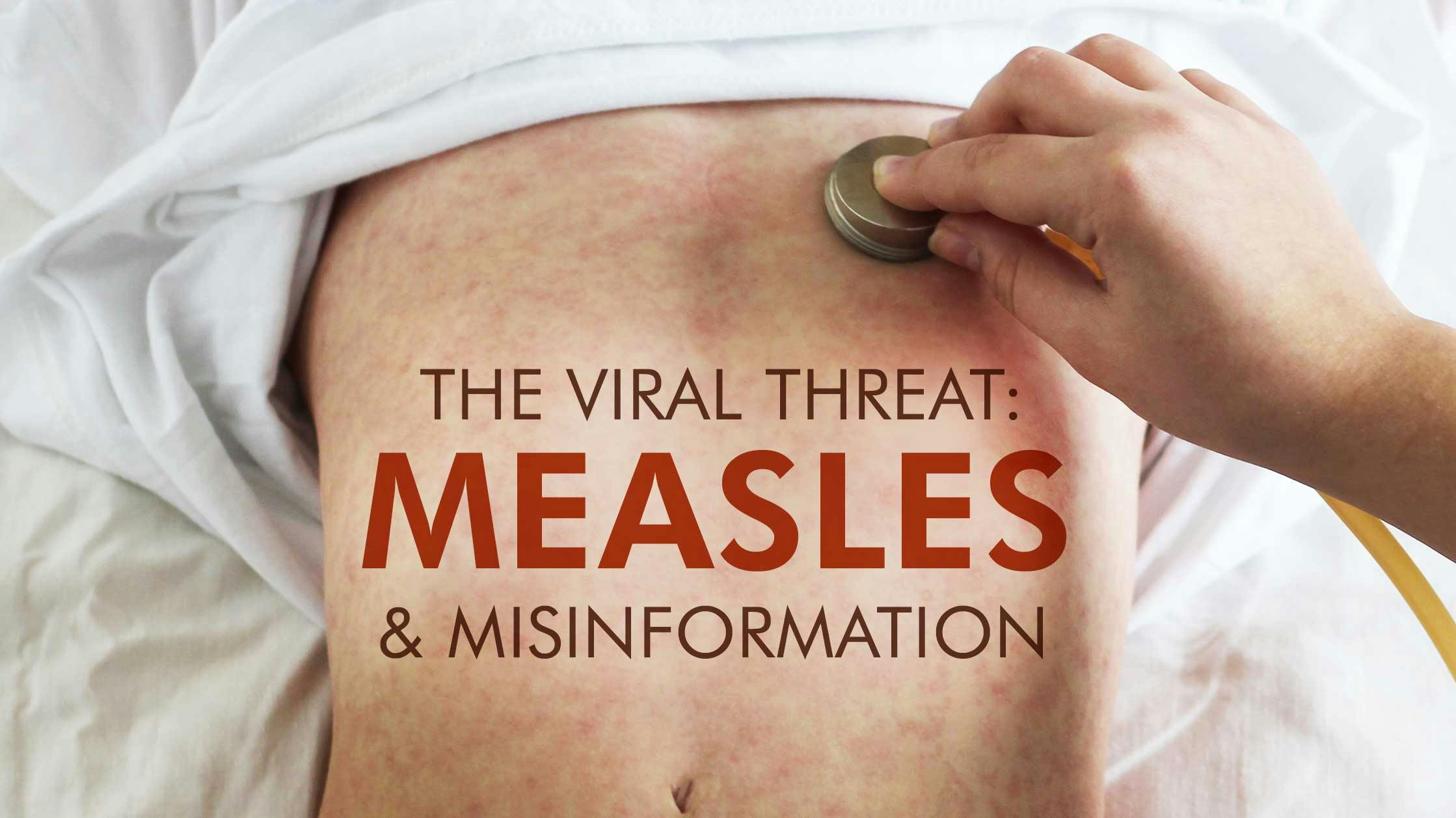 The Viral Threat: Measles and Misinformation